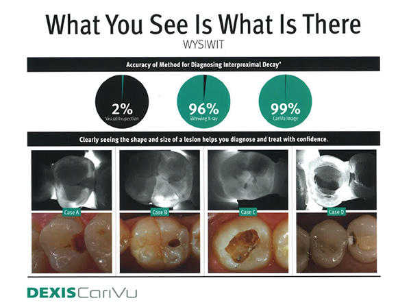 CariVu - A new view at tooth decay