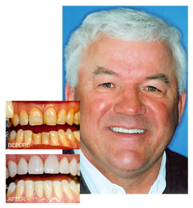 porcelain veneeers patient, Dr. Larry Stone